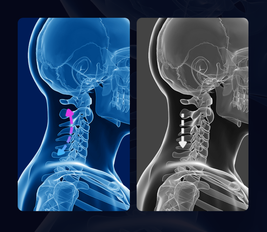Tracción cervical del cuello